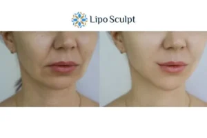 Explaining Morpheus8 And What It Can Do For You 2 Do you want to boost your self confidence? Give Morpheus8 Leigh-on-Sea a try today!