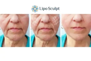 Explaining Morpheus8 And What It Can Do For You 3 Boost your confidence with Morpheus8 Leigh-on-Sea call our team today!