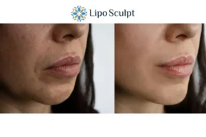 Explaining Morpheus8 And What It Can Do For You 4 Morpheus8 Leigh-on-Sea the best results - call our team today!