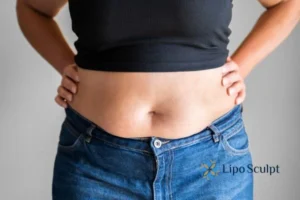 Bidding Farewell to Muffin Tops with Aqualyx Fat Injections 2 Do you wish you could reduce your muffin top Leigh-on-Sea With Aqualy fat dissolving injections you can!