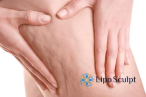 CoolSculpting for Legs: The Innovative Approach to Redefining Your Legs 5 Start your journey today book your coolsculpting treatment Leigh-on-Sea online today!