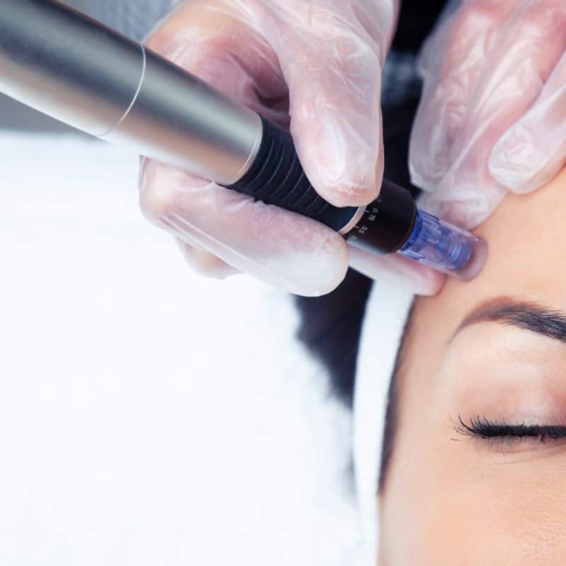 Morpheus8 treatment Leigh-on-Sea from Lipo Sculpt - Book in today!
