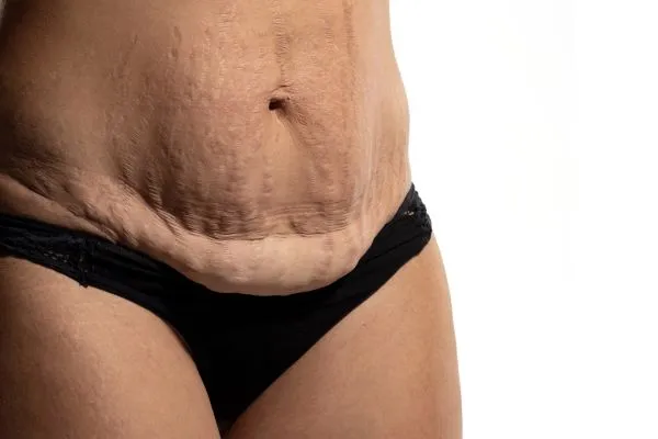 Lost the Weight but Not the Loose Skin? 1 image of womans stomach after weight loss showing loose skin Leigh-on-Sea